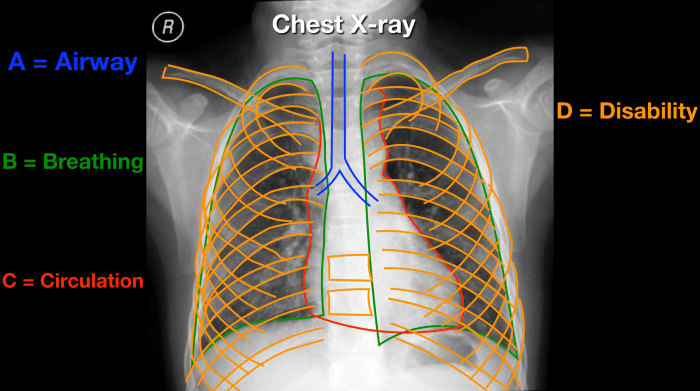 Abdomen radiology xray radiographic abdominal labeled supine radiography kub imaging bowel labelled grepmed quadrants nurse humor ped