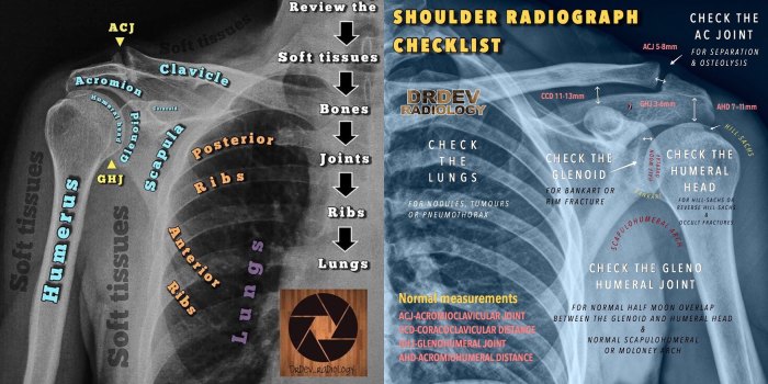 Knuckle aortic aortopulmonary interpretation cxr rays radiograph